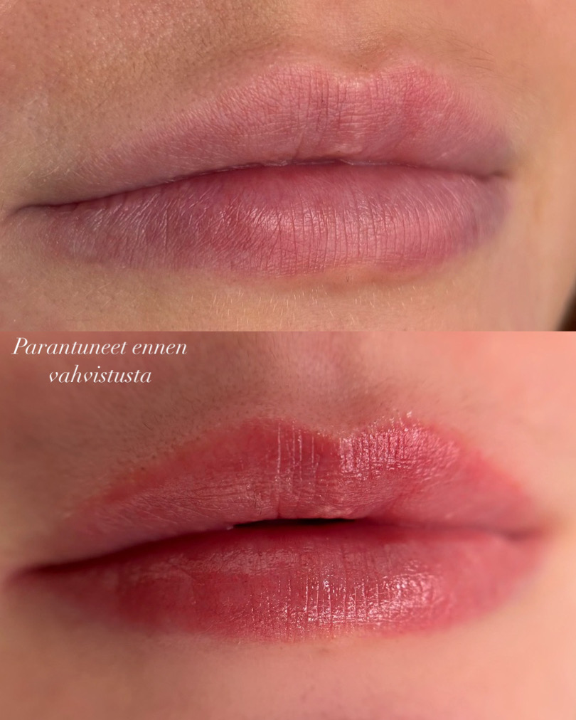 Parantuneet huulet ennen vahvistusta / The Beauty Ateljé Oulu